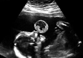 Ta kobieta myślała, że jej dziecko na usg puszcza bańki. Wtedy lekarze przekazali jej zaskakującą wiadomość