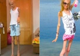 Jak dziś wygląda Ksenia Bubenko, która ważyła zaledwie 23 kilogramy