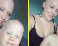 Łysa mama postanowiła nie nosić peruk dla córki, która również cierpi na łysienie