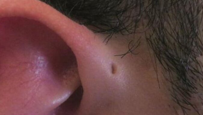 W niektórych krajach nawet 10% dzieci rodzi się z dziwną dziurką przy uchu