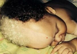 Jak wygląda teraz chłopiec o niezwykłym wyglądzie, który urodził się 6 lat temu