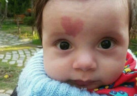 Oto jak wygląda teraz chłopiec, który urodził się ze znamieniem w kształcie serca na czole?