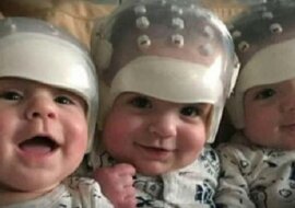 Najrzadsze trojaczki świata. Zobacz, jak wyglądają po historycznej operacji